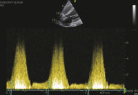 Abbildung 19: CW-Doppler - VSD