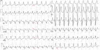 Abbildung 1: EKG