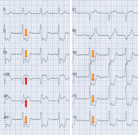 Abbildung 1: EKG