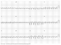 Abbildung 1: 12-Kanal-EKG