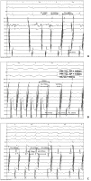 Abbildung 2: EKG