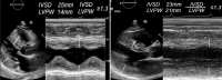 Abbildung 2: Hypertrophe Kardiomyopathie - Kardiale Amyloidose