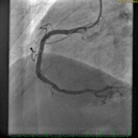 Abbildung 3: Angiogramm