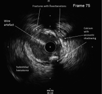 Abbildung 4: IVUS