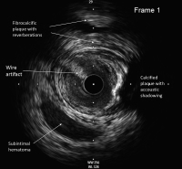 Abbildung 5: IVUS