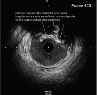 Abbildung 6: IVUS