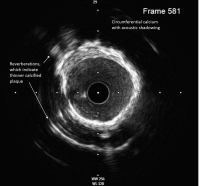 Abbildung 8: IVUS