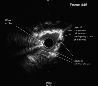 Abbildung 9: IVUS