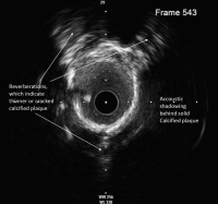 Abbildung 16: IVUS