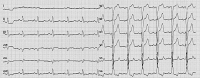 Abbildung 2: EKG