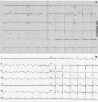 Abbildung 3: EKG