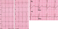 Abbildung 1: EKG