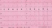 Abbildung 4: EKG
