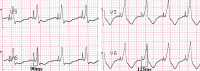 Abbildung 5: EKG