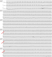 Abbildung 3: EKG