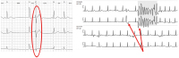 Abbildung 5: Holter-EKG