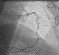 Abbildung 1: Aneurysma