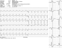 Abbildung 2: EKG