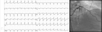 Abbildung 3: EKG - Angiographie