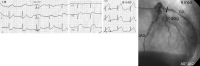 Abbildung 4: EKG - Angriographie