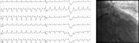 Abbildung 5: EKG - Angiographie