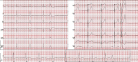Abbildung 3: EKG