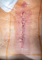 Abbildung 1: Dermabond + Prineo
