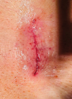 Abbildung 2: Dermabond