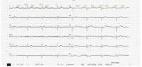 Abbildung 1: EKG