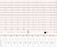 Abbildung 2: EKG