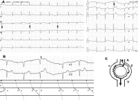 Abbildung 4: EKG