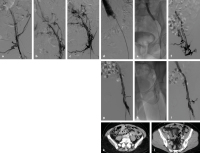 Abbildung 1a-l: Postthrombotisches Syndrom 