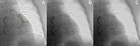 Abbildung 1: CardioMEMS HF-System - Implantation