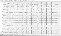 Abbildung 1: 12-Ableitungs-EKG