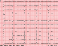 Abbildung 1: EKG bei der Aufnahme