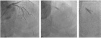 Abbildung 9a-c: Angiographie