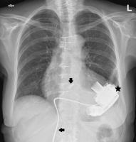 Abbildung 1: Thorax-Rntgen