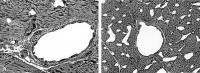 Figure 1: Nephrektomie - Wandverdickung