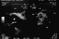 Figure 1: Endokarditis - Diagnose - TEE