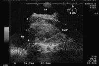 Figure 2: Endokarditis - Diagnose - TEE