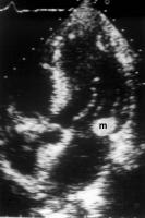 Figure 1: Endokarditis - Diagnose - TEE