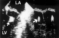 Figure 2: Endokarditis - Diagnose - TEE