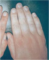 Abbildung 1: Raynaud-Phnomen