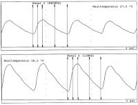 Abbildung 3b: Raynaud-Phnomen