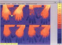 Abbildung 5: Raynaud-Phnomen