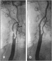 Abbildung 1a-b: ACI-Stenose - Stent