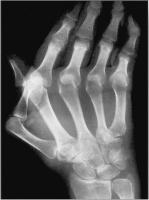 Abbildung 8: Raynaud-Phnomen