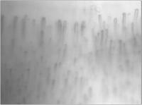 Abbildung 9: Raynaud-Phnomen