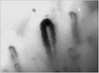 Abbildung 11: Raynaud-Phnomen