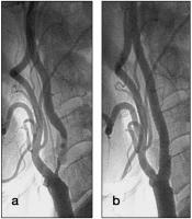 Abbildung 2a-b: ACI-Stenose - Stent